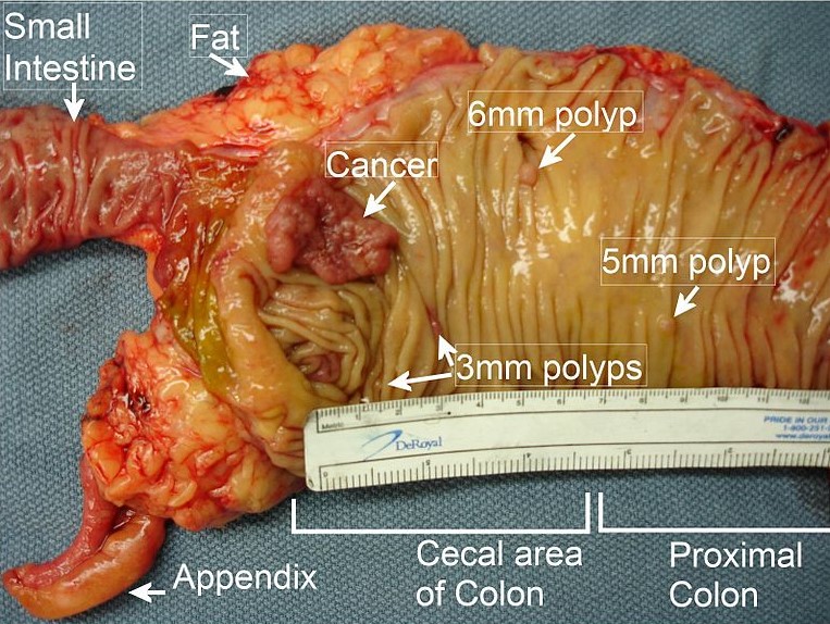 Image of resected colon segment with cancer by <a href="http://www.achsc.org.au/syllabus/3-34/%E2%80%9Dhttps://commons.wikimedia.org/w/index.php?title=User:Bernstein0275&action=edit&redlink=1%E2%80%9D">Bernstein0275</a> [edited] / <a href="https://commons.wikimedia.org/wiki/Category:CC-BY-SA-3.0">CC-BY-SA-3.0</a>